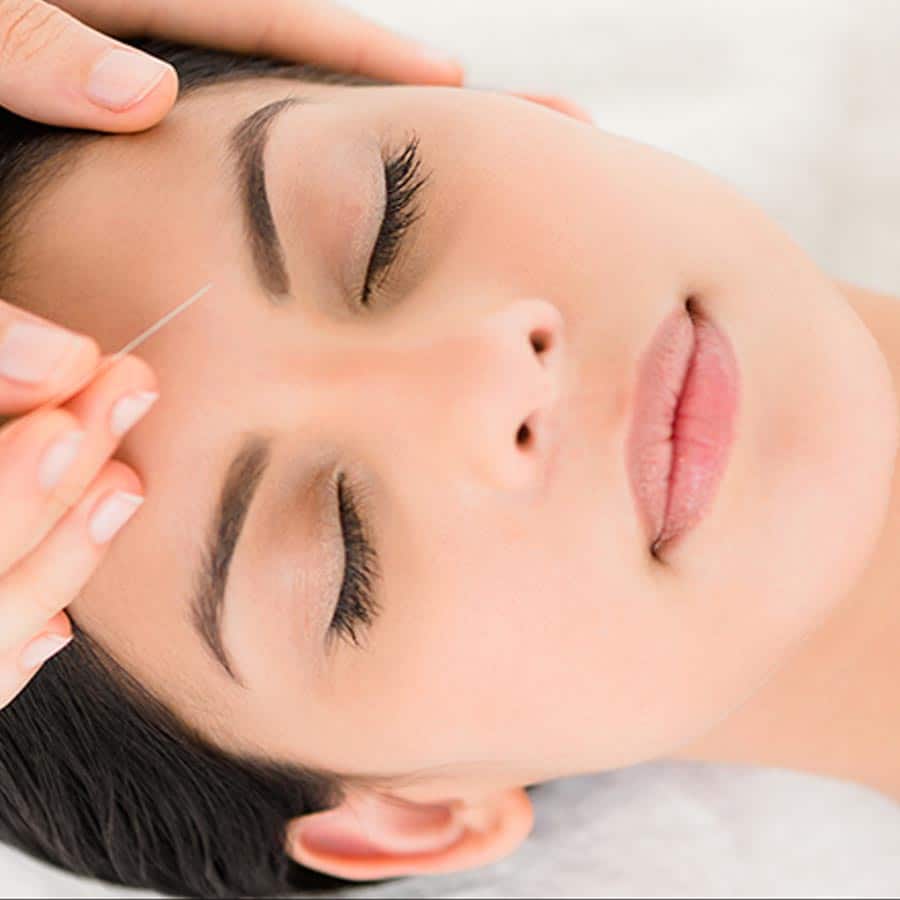 facial acupuncture