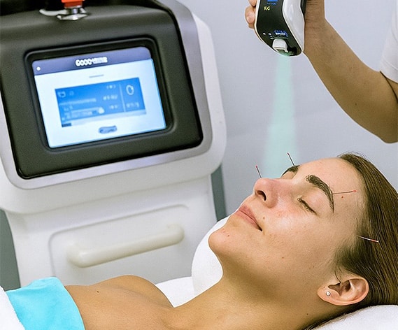 acupuncture facial